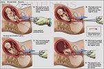 aborcja 1